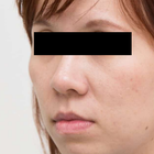 Compare Before & After Photos of _procedure_photos.phpHigh-Intensity Focused Ultrasound (HIFU)