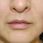 Compare Before & After Photos of _procedure_photos.phpHigh-Intensity Focused Ultrasound (HIFU)