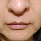 Compare Before & After Photos of _procedure_photos.phpHigh-Intensity Focused Ultrasound (HIFU)