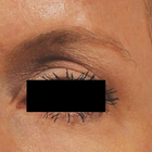 Compare Before & After Photos of _procedure_photos.phpHigh-Intensity Focused Ultrasound (HIFU)