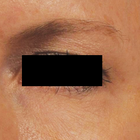 Compare Before & After Photos of _procedure_photos.phpHigh-Intensity Focused Ultrasound (HIFU)