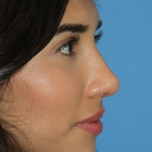 Compare Before & After Photos of _procedure_photos.phpNose Surgery