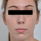 Compare Before & After Photos of _procedure_photos.phpNose Surgery