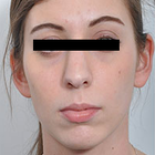 Compare Before & After Photos of _procedure_photos.phpNose Surgery