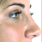 Compare Before & After Photos of _procedure_photos.phpNose Surgery