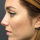 Compare Before & After Photos of _procedure_photos.phpNose Surgery