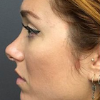 Compare Before & After Photos of _procedure_photos.phpNose Surgery