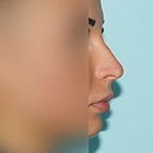 Compare Before & After Photos of _procedure_photos.phpNose Surgery
