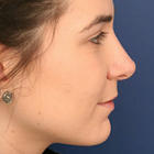 Compare Before & After Photos of _procedure_photos.phpNose Surgery