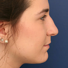Compare Before & After Photos of _procedure_photos.phpNose Surgery