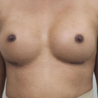 Compare Before & After Photos of _procedure_photos.phpMale Breast Augmentation