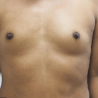 Compare Before & After Photos of _procedure_photos.phpMale Breast Augmentation
