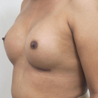 Compare Before & After Photos of _procedure_photos.phpMale Breast Augmentation