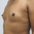 Compare Before & After Photos of _procedure_photos.phpMale Breast Augmentation