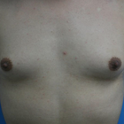 Compare Before & After Photos of _procedure_photos.phpMale Breast Augmentation