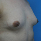 Compare Before & After Photos of _procedure_photos.phpMale Breast Augmentation