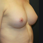 Compare Before & After Photos of _procedure_photos.phpMale Breast Augmentation