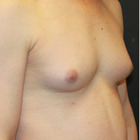 Compare Before & After Photos of _procedure_photos.phpMale Breast Augmentation