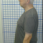 Compare Before & After Photos of _procedure_photos.phpChiropractic Treatment