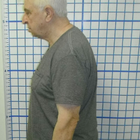 Compare Before & After Photos of _procedure_photos.phpChiropractic Treatment