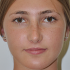 Compare Before & After Photos of _procedure_photos.phpRhinoplasty