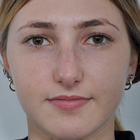 Compare Before & After Photos of _procedure_photos.phpRhinoplasty