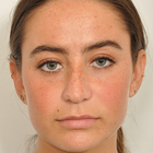 Compare Before & After Photos of _procedure_photos.phpRhinoplasty