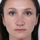 Compare Before & After Photos of _procedure_photos.phpRhinoplasty