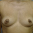 Compare Before & After Photos of _procedure_photos.phpBreast Augmentation