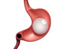 Search and Compare the Best Clinics and Doctors at the Lowest Prices for Gastric Balloon Treatment in Indonesia