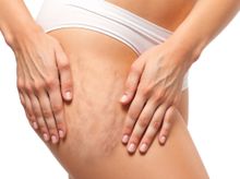 Search and Compare the Best Clinics and Doctors at the Lowest Prices for Cellulite Treatment in Ledang Heights