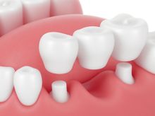 Search and Compare the Best Clinics and Doctors at the Lowest Prices for Dental Bridge in Philippines