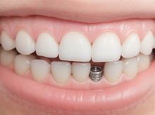 Search and Compare the Best Clinics and Doctors at the Lowest Prices for Dental Implant in Vietnam