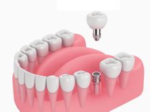 Search and Compare the Best Clinics and Doctors at the Lowest Prices for Dental Implant Bars in United Kingdom