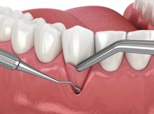 Search and Compare the Best Clinics and Doctors at the Lowest Prices for Gum Tissue Graft in Thailand