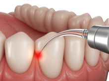 So sánh Mức giá, Chi phí và Đánh giá cho Điều trị bệnh nướu răng bằng laser tại Cần Thơ