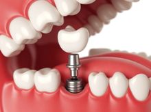 Search and Compare the Best Clinics and Doctors at the Lowest Prices for Mini Dental Implant in Valencia