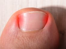 Search and Compare the Best Clinics and Doctors at the Lowest Prices for Ingrown Toenail Treatment in Wiesbaden