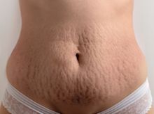 Search and Compare the Best Clinics and Doctors at the Lowest Prices for Stretch Marks Removal in Quezon
