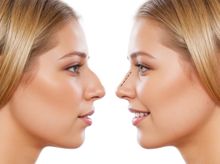 Search and Compare the Best Clinics and Doctors at the Lowest Prices for Septoplasty in Munich