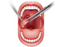 Search and Compare the Best Clinics and Doctors at the Lowest Prices for Tonsillectomy in Vietnam