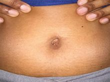 Search and Compare the Best Clinics and Doctors at the Lowest Prices for Umbilical Hernia Repair in Hildesheim