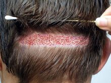 Search and Compare the Best Clinics and Doctors at the Lowest Prices for Hair Implant in San Fernando