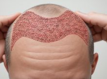Search and Compare the Best Clinics and Doctors at the Lowest Prices for Hair Transplant in Philippines