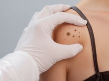 Search and Compare the Best Clinics and Doctors at the Lowest Prices for Mohs Skin Cancer Surgery in Pilar