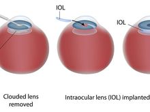 Search and Compare the Best Clinics and Doctors at the Lowest Prices for Intraocular Lens (IOL) Implant in Schwerin