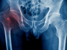 Search and Compare the Best Clinics and Doctors at the Lowest Prices for Hip Fracture Surgery in Heidelberg