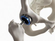 Search and Compare the Best Clinics and Doctors at the Lowest Prices for Hip Replacement in Hildesheim