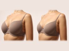 Search and Compare the Best Clinics and Doctors at the Lowest Prices for Breast Implant Removal in Philippines