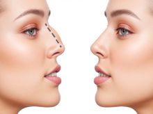 Search and Compare the Best Clinics and Doctors at the Lowest Prices for Nose Surgery in Vietnam